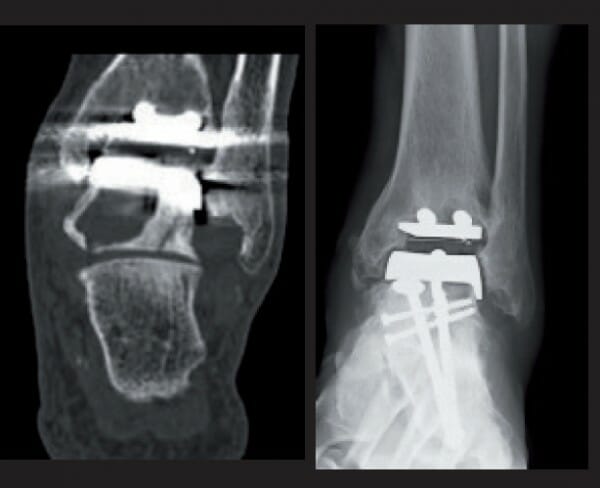 Periprothetische Zysten nach Sprunggelenkendoprothetik - Orthopädie ...