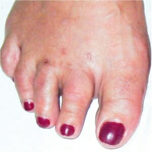 6 Wochen nach minimal invasiver Korrekturoperation