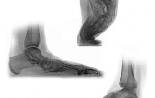 SYMPOSIUM UPDATE 2016: FUSS & SPRUNGGELENK