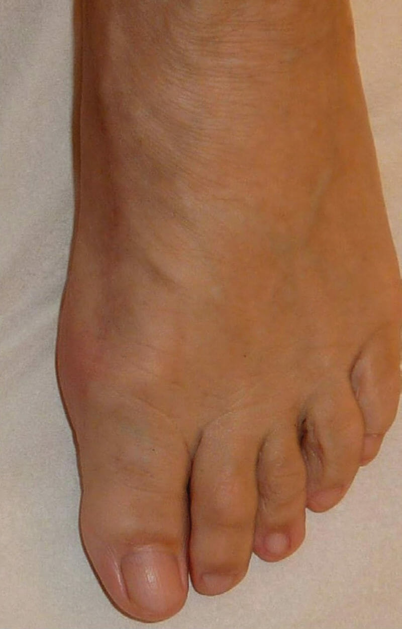 Hallux valgus Orthopädie Zentrum Arabellapark München