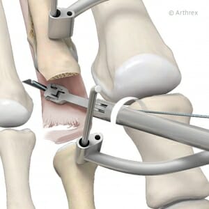 Aufspreizen des Gelenkes und Annaht der plantaren Platte.