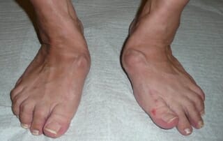 Dr Kinast OZA Lisfranc prä klin ap