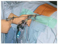 Endoskopische Bandscheibenoperation