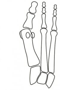 Fuß mit Hallux valgus-Fehlstellung