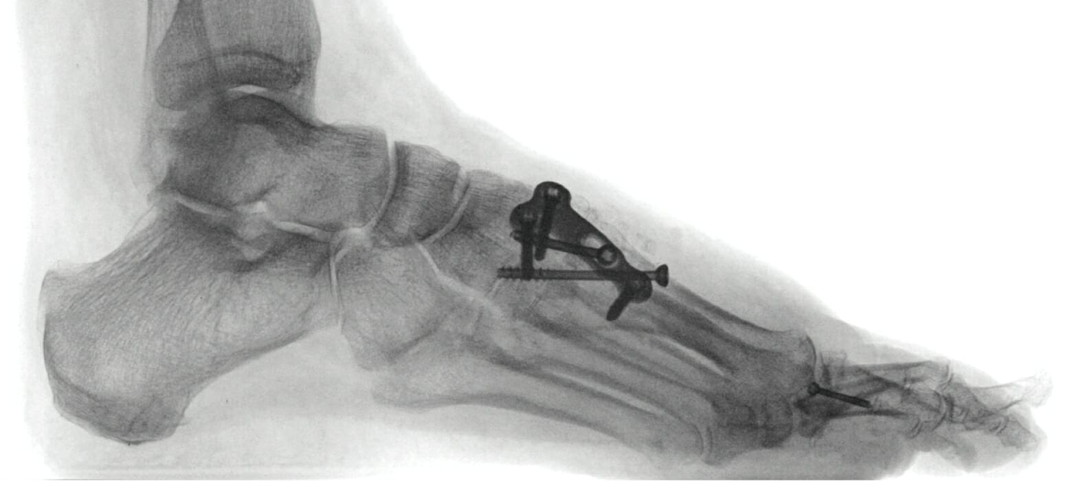 Hallux valgus Behandlung und Operation Orthopädie Zentrum Arabellapark München