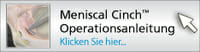Meniscal Cinch