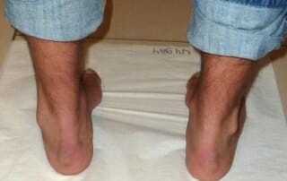 Hohlfuß mit Schmerzen hinter dem Aussenknöchel links bei Peronealsehnensplit Läsion