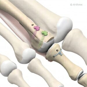 Osteotomie des Mittelfußknochen 2, Naht der plantaren Platte und Verschraubung mit 12 mm bzw. 11 mm Schrauben.