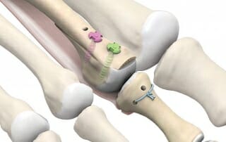 Osteotomie Mittelfuss