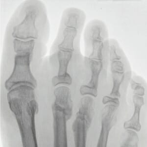 Percutane Osteotomie am Großzeh; geheilte Osteotomien M 2, M 3; basisnahe Osteotomien Z 2, 3, 4.