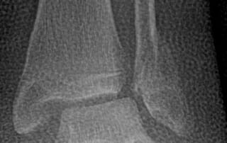 Roentgenbild eines Sprunggelenkverrenkungsbruches von vorne