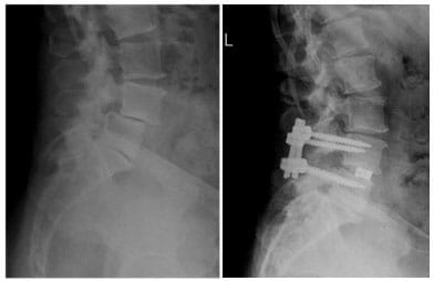 Stabilisierungsoperation LWK4/5