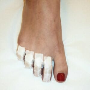 Taping der Zehengrundgelenke nach plantar und in der Zehenachse. Streckung der PIP und DIP.