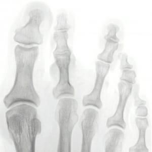 Überlänge des Mittelfußknochens 2 und 3; Z 2 steht zur Innenseite orientiert; Z 3 nach aussen; Biegung im Großzeh nach aussen.