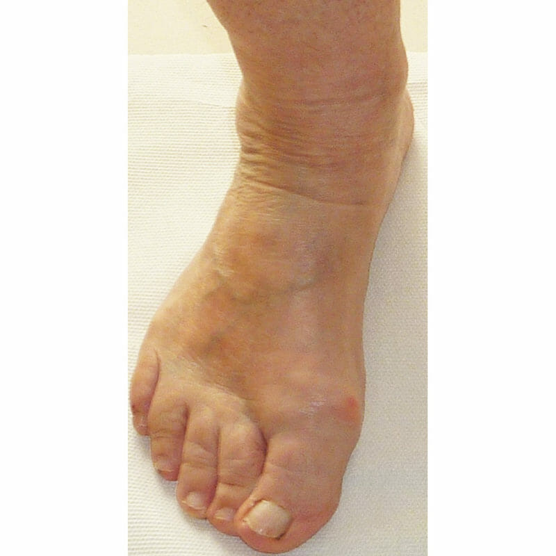 Hallux rigidus Gelenkverschleiß am Großzehengrundgelenk Orthopädie