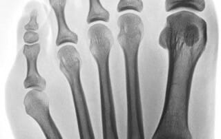 OZA Dr. Fröhlich Schneiderballen - mit Hallux valgus - Röntgenbild