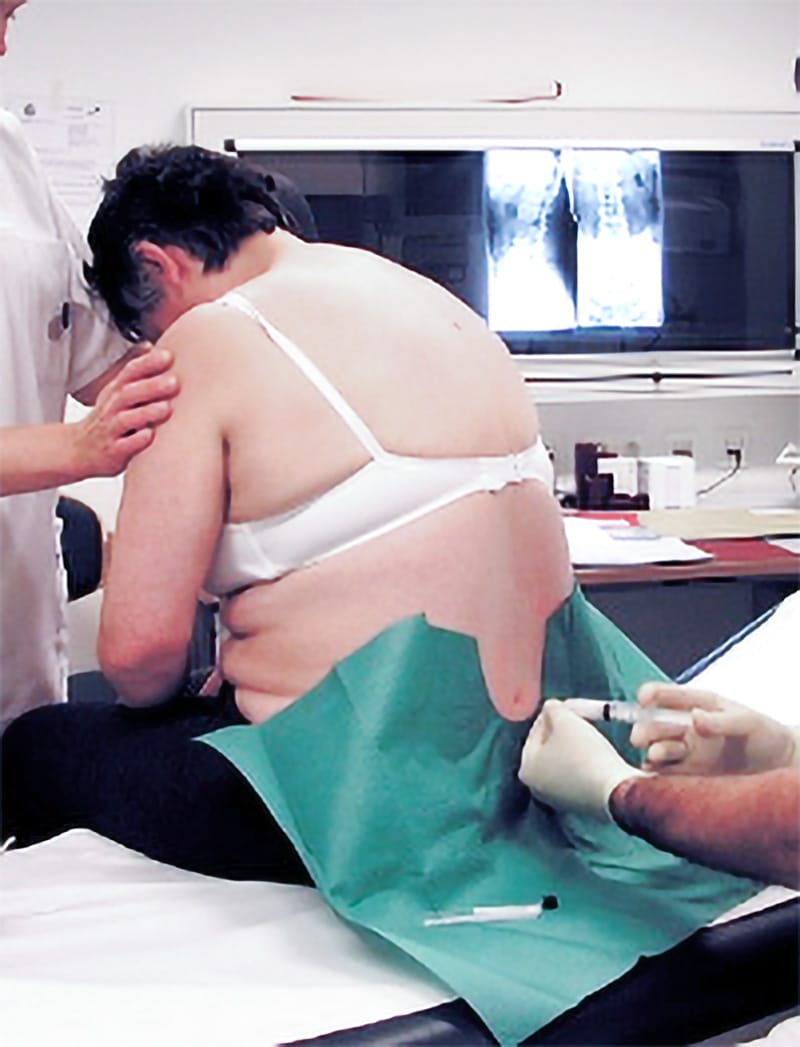 Wachoperation bei Bandscheibenvorfäll oder Spinalkanalstenose Wachoperation bei Bandscheibenvorfäll oder Spinalkanalstenose